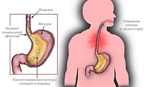heartburn thumbnail
